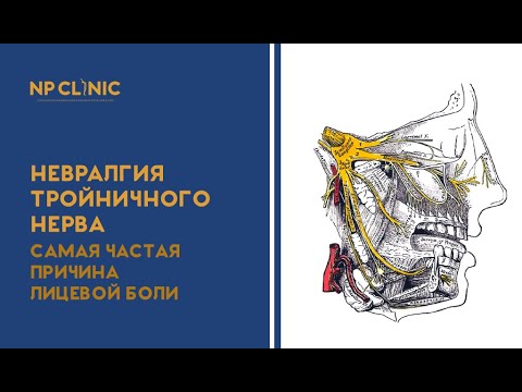 Невралгия тройничного нерва: самая частая причина лицевой боли