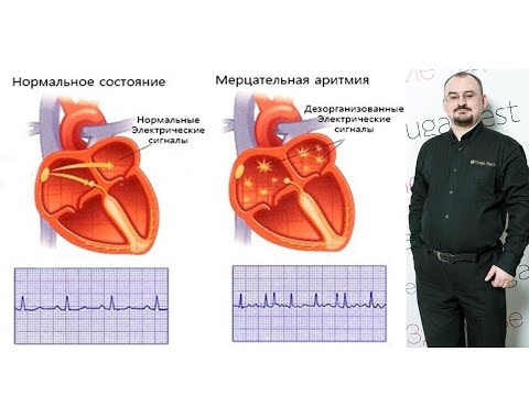 Мерцательная аритмия – проявление и лечение