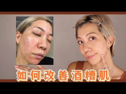 酒糟肌會好嗎？酒糟人生該注意什麼？能恢復正常肌膚嗎？｜Nita