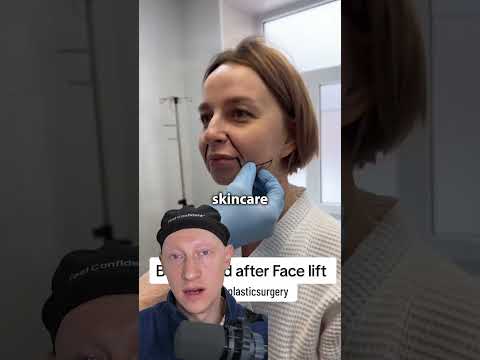 INCREDIBLE Facelift Result | Plastic Surgeon Reacts