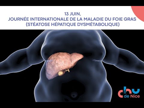 Conférence sur la stéatose hépatique dysmétabolique (MASLD, MASH) - CHU de Nice