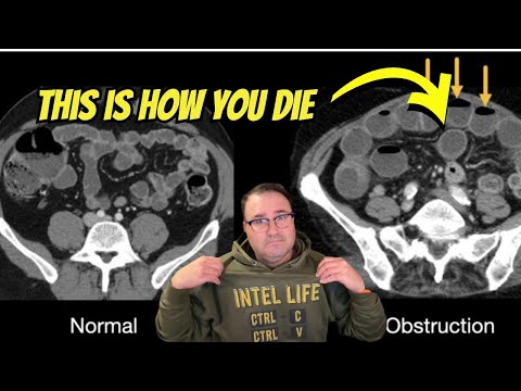 How I Almost Died (Again) - Watch this if you're over 40.