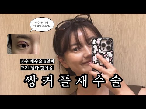 Double eyelid revision surgery: One-week swelling, natural adhesion double eyelid surgery review ...