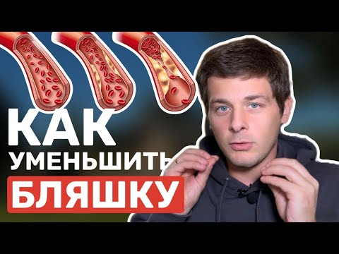 Как уменьшить атеросклеротическую бляшку