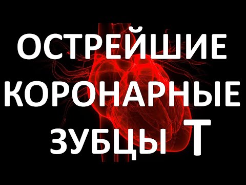 ОСТРЕЙШИЕ КОРОНАРНЫЕ Т: ПЕРВЫЙ ЭКГ ПРИЗНАК ИНФАРКТА МИОКАРДА
