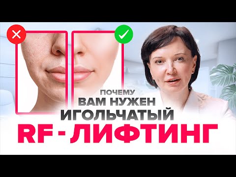 ИГОЛЬЧАТЫЙ RF ЛИФТИНГ. Почему после 35 лет он нужен всем, а кому-то даже раньше | Ирина Рахова