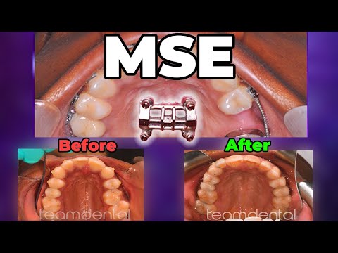 What is MSE? - Maxillary Skeletal Expander - Dr. Kennedy