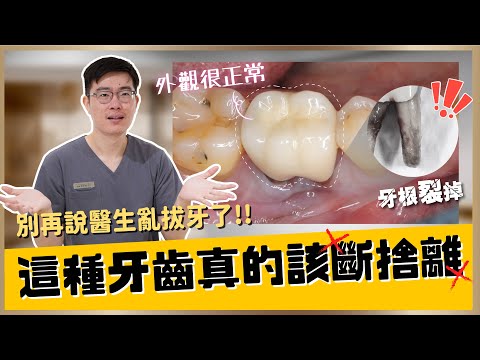 【假牙 #6】為什麼需要拔牙？只要出現深度蛀牙、牙齒殘根、牙根斷裂和牙周病這幾種狀況，建議就將牙齒拔掉處理！絕對不是外觀沒事就OK ｜【祐民牙醫－隱適美旗艦店】許文斌醫師（大許醫師）#拔牙  #牙周病