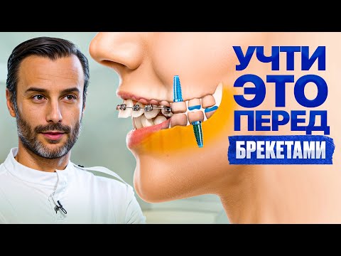 5 рекомендаций ортодонта перед установкой брекетов
