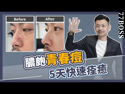 膿皰青春痘5天快速痊癒，學會這秘訣，痘痘好超快！！【77老大】