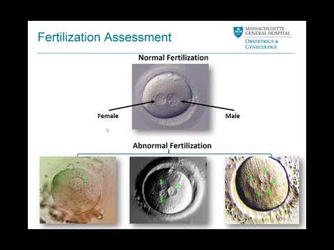 Embryo Selection and Transfer - Mass General Fertility Focus Webinar