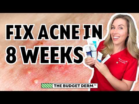 Fix Acne In 8 Weeks! | Step-by-Step Skincare Routine by The Budget Derm