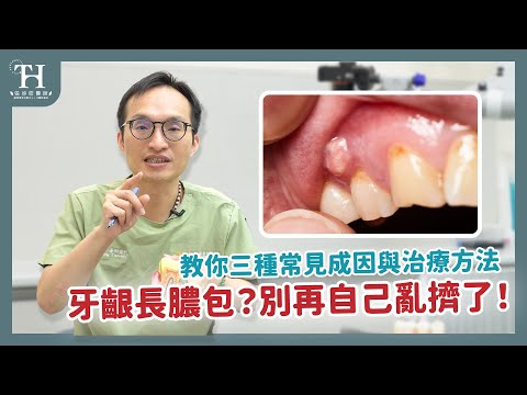 🚫 牙齦膿包火氣大？ 怎麼辦？牙醫警告錯誤迷思 ，恐釀蜂窩性組織炎！蛀牙、牙周病是元凶？🚨 牙齦長膿包，像長痘痘，會自己好嗎？