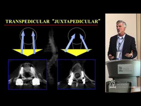 Thoracic Pedicle Screws - Michael Daubs, MD