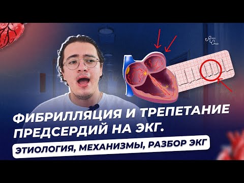 Фибрилляция и трепетание предсердий на ЭКГ  Этиология, механизмы, разбор ЭКГ