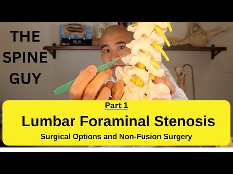 Lumbar Foraminal Stenosis - Decompression Surgery to Avoid Fusion