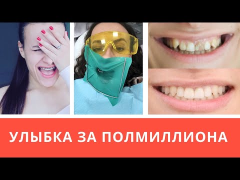 МОЯ ИСТОРИЯ ЗУБОВ - УЛЫБКА ЗА ПОЛМИЛЛИОНА