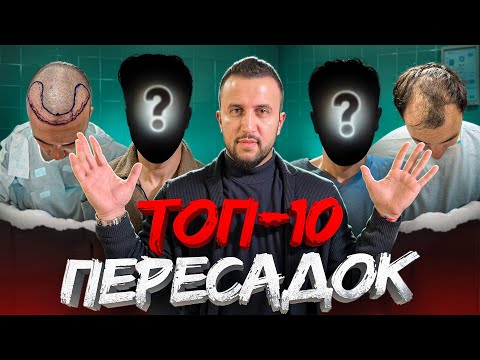 TOP 10 HAIR TRANSPLANT RESULTS