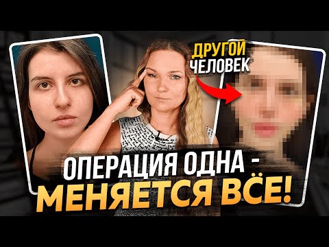 ВЕРХНЯЯ БЛЕФАРОПЛАСТИКА - СМОТРИТЕ ПЕРЕД ТЕМ, КАК ДЕЛАТЬ!