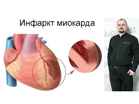 Инфаркт миокарда – проявление и лечение.