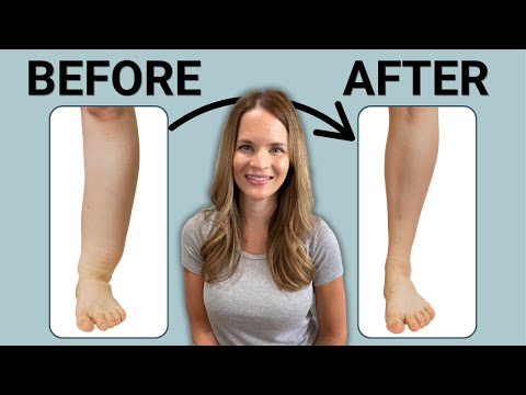 The Best Leg Lymphedema Treatment