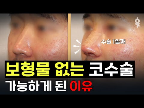 Rhinoplasty Part 2! Swelling, bruising, and silicone—what's the secret to this rhinoplasty?