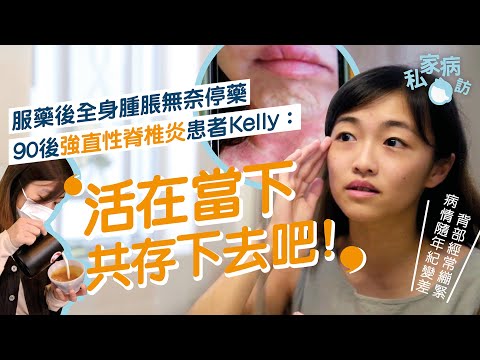 每朝晨僵半個鐘  罕見藥物反應 導致壞肝出疹  90強直性脊椎炎 患者停藥 與病共存｜直性脊椎炎 晨僵 藥物反應 罕見 壞肝出疹｜#私家病訪｜#8杯水