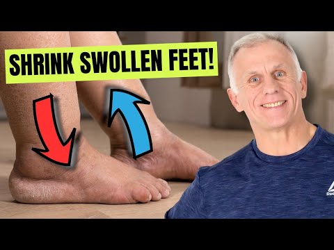 Best Remedies for Swollen Feet