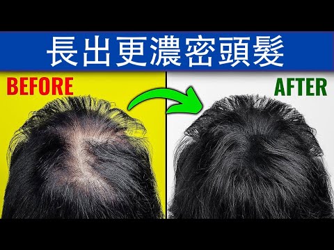 如何長出濃密頭髮?營養和秘訣,柏格醫生 Dr Berg