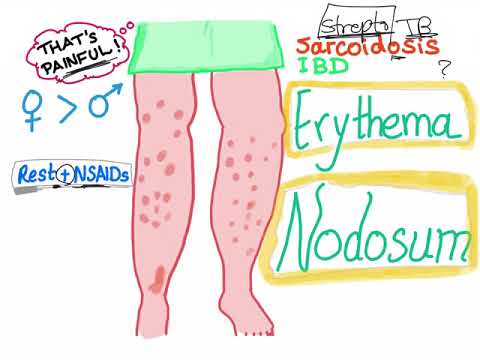 Erythema Nodosum