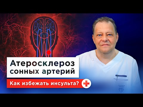 Холестерин, бляшки, инсульт... Все о профилактике и лечении атеросклероза сонных артерий по ОМС