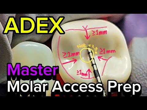 [ADEX] Mastering ADEX Molar Access Prep: A Comprehensive Guide