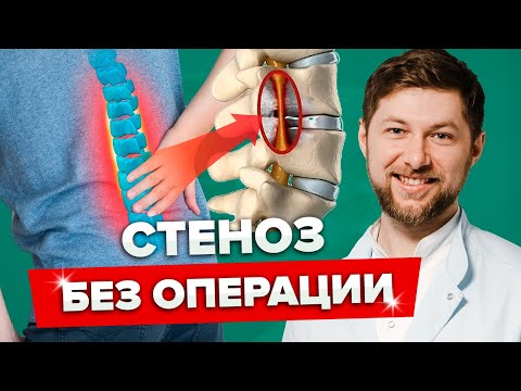 КАК ЛЕЧИТЬ СТЕНОЗ БЕЗ ОПЕРАЦИИ! Причины появления стеноза позвоночного канала