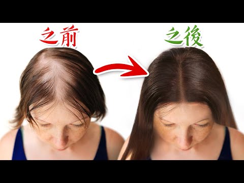 長出濃密頭髮5個秘訣,自然療法,柏格醫生 Dr Berg