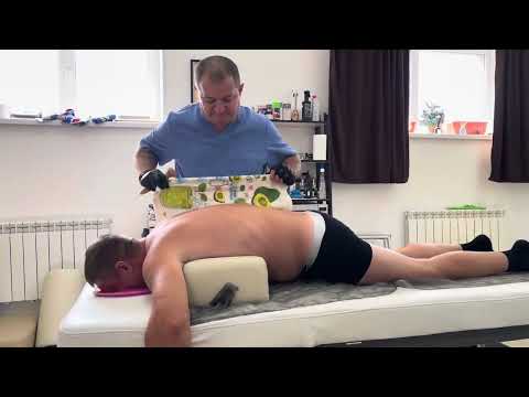 Защемление седалищного нерва,корешковый синдром в действии!