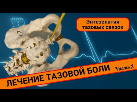 ТАЗОВАЯ БОЛЬ. ЛЕЧНИЕ. (Часть 2)