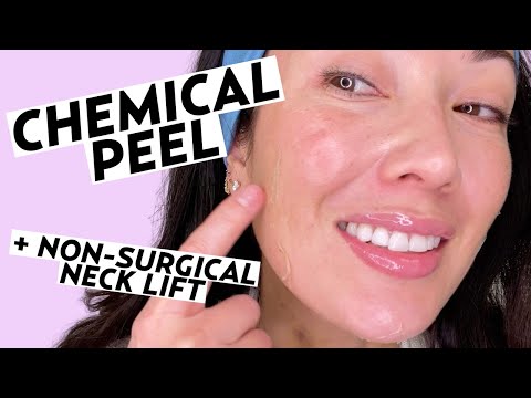 Getting a Vi Peel Chemical Peel & Non-Surgical Neck Lift! | Skincare with Susan Yara