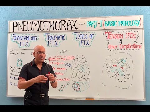 Pneumothorax | Spontaneous, Tension & Traumatic🫁