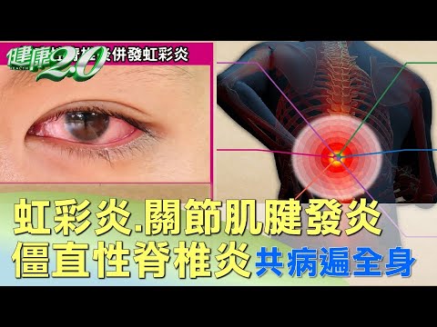虹彩炎.關節肌腱發炎 僵直性脊椎炎共病遍全身 健康2.0