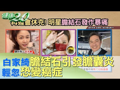 白家綺急開刀! 膽結石引發膽囊炎 輕忽恐變癌症 健康2.0