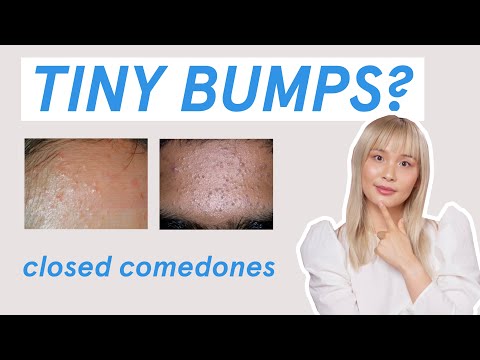 Why those tiny bumps AREN’T fungal acne!