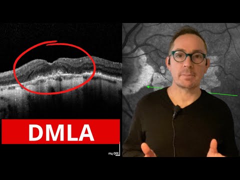 La DMLA et ses Solutions (Maladie des yeux)