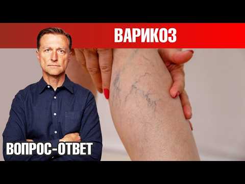 Как избавиться от варикоза 👉 лучший способ и профилактика