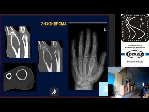 Дифференциальная диагностика злокачественных опухолей костей: доброкачественные образования