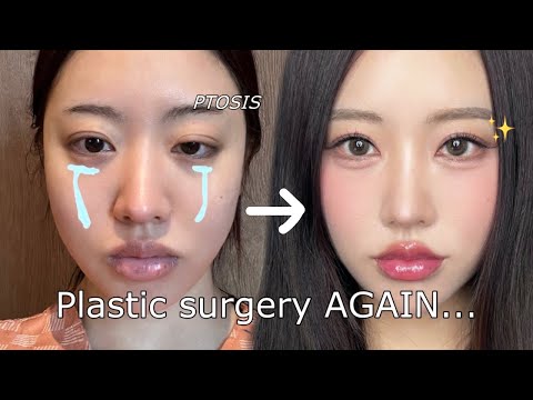 I got my eyes done AGAIN in korea😭 Plastic surgery vlog!