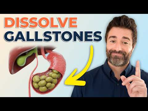 How to Get Rid of Gallstones Naturally