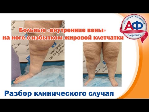 Больные "внутренние вены" на ногах с избытком жировой клетчатки.