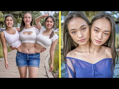 15 Most Incredible Conjoined Twins That Touched the World’s Heart