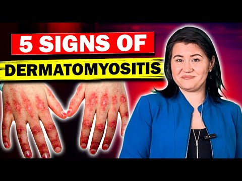 5 Signs of Dermatomyositis and Polymyositis