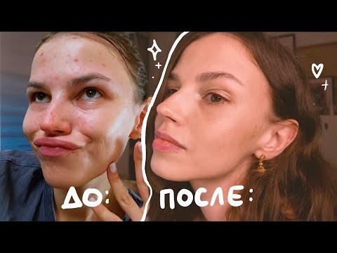 как вылечить прыщи. единственный 100% способ